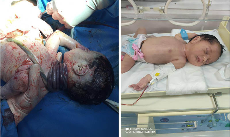نجات نوزاد تازه متولد شده در بیمارستان فجر ماکو